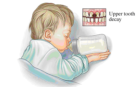 La carie dei denti da latte: semplici regole per ridurre il rischio