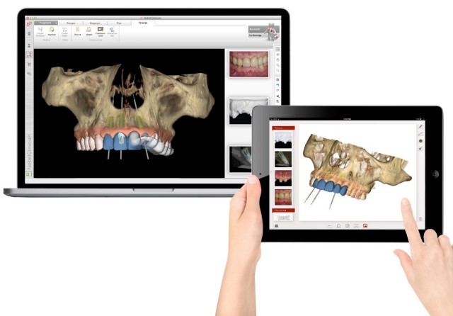implantologia computer guidata
