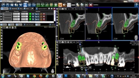 implantologia computerizzata